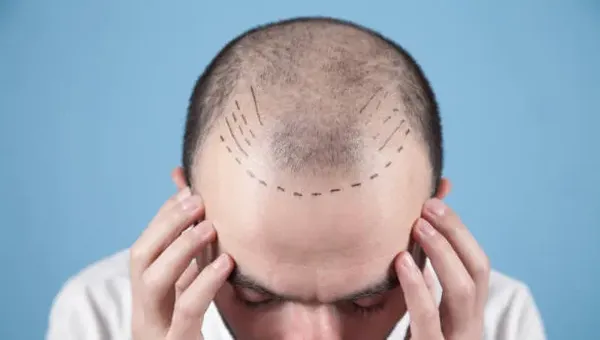 Man with thinning hair, representing the before stage of an effective and affordable hair transplant cost Mexico procedure.