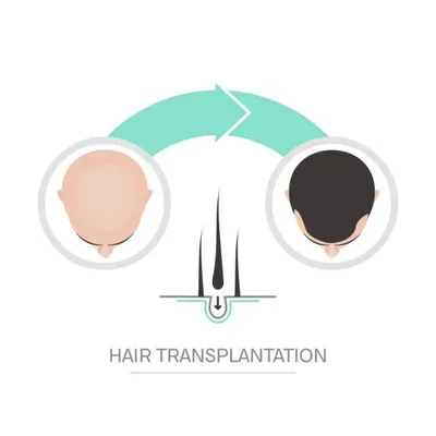Illustration comparing the results before and after a hair transplant, emphasizing how how much is a hair transplant impacts hair restoration.