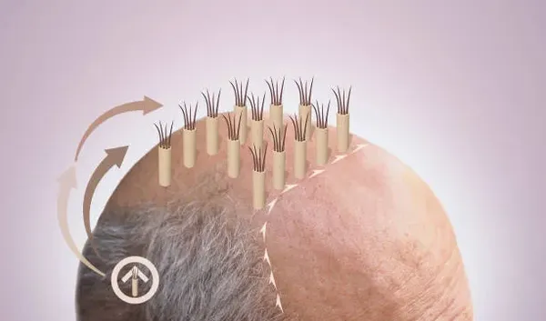 Illustration showing hair grafts being implanted into a man's scalp, addressing whether is hair transplant permanent for permanent hair restoration.