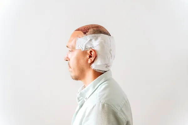 Paciente con injerto de cabello con cuidados postrasplante que muestra el cuero cabelludo cubierto y vendajes para proteger los folículos recién trasplantado.