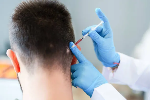 Doctor injecting a man's scalp as part of best hair transplant technology for natural and lasting hair restoration