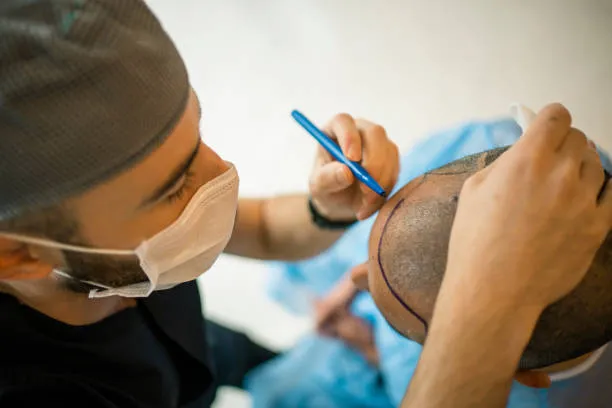 Doctor marking the scalp, illustrating essential hair transplant facts and myths for successful transplant results