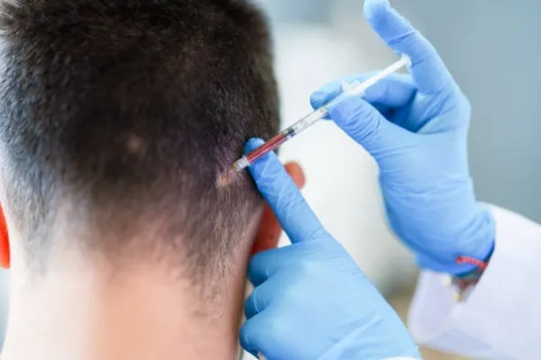 Medical professional carefully injecting PRP into the scalp during a PRP injection in Cancun session, a proven method to enhance hair follicle activity.