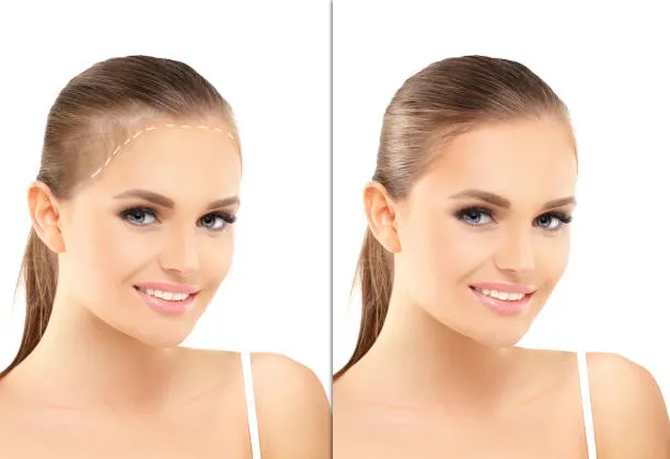 Visible improvement in the appearance of a woman’s frontal hairline, shown in a before and after scalp micropigmentation comparison.