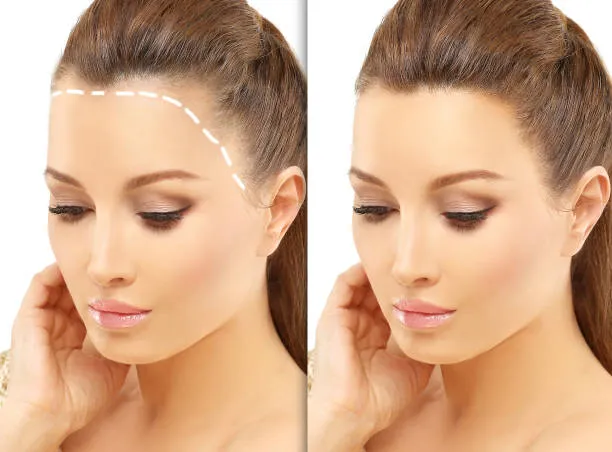 Side-by-side comparison showing a woman’s frontal hairline visibly fuller after undergoing a traditional FUT hair transplant procedure.