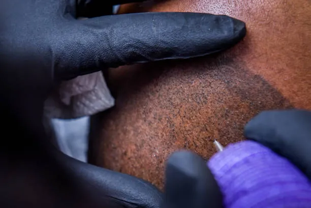 Close-up of scalp being treated with cosmetic pigmentation to simulate natural hair appearance in scalp micropigmentation.