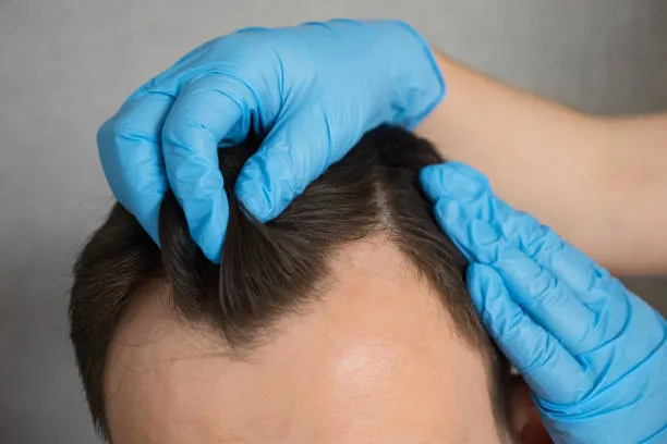 Close-up of a man’s forehead showing signs of hair loss, highlighting the ideal area to begin an artas hair transplant recovery process naturally
