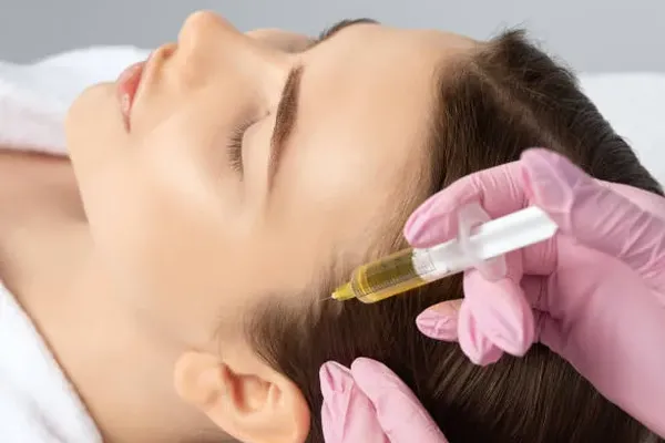 PRP injection technique applied to a woman to stimulate hair growth and reverse early-stage hair loss