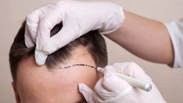 A man with visible hair loss looking at potential treatment results, reflecting decision-making related to the types of surgeries for alopecia.