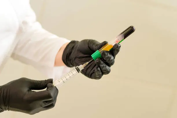 A syringe filled with platelet-rich plasma ready for use, illustrating part of the tools in procedures like prp treatment vs hair transplant.