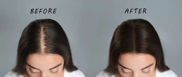 Visual before-and-after transformation of a woman with alopecia treated through advanced types of surgeries for alopecia and hair recovery.
