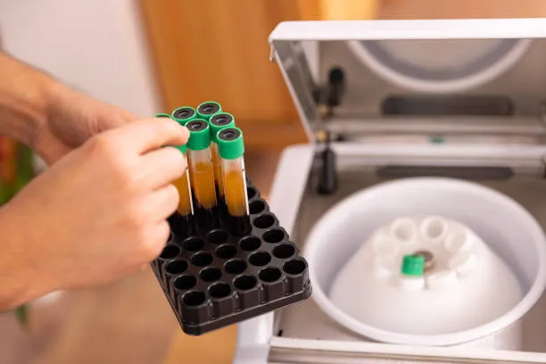 Test tubes filled with formulas for hair restoration, illustrating modern and effective treatments compared in Stem Cell Therapy vs PRP.
