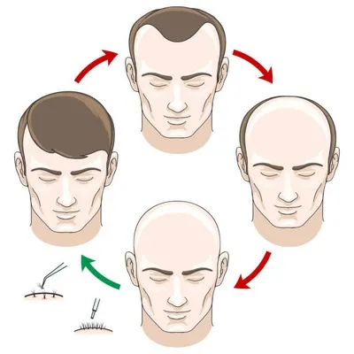 Illustrated stages of a bald man before and after treatment, highlighting different types of alopecia and options for regrowth solutions for hair loss.