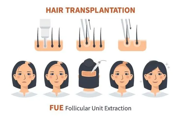 Detailed diagram of a FUE process demonstrating a modern solution for treating some types of alopecia and encouraging natural hair regrowth