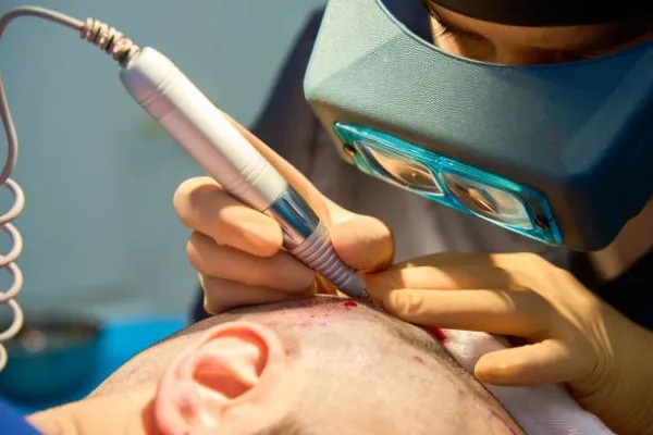 Close-up of doctor injecting hair follicles into a patient’s scalp, showcasing precision and method in DHI vs FUE Hair Transplant.