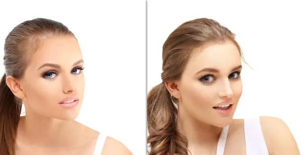 Side-by-side comparison showing a woman before and after FUT hair transplant, highlighting fuller and natural-looking hair restoration results.