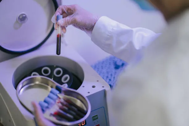 Doctor preparing a medical centrifuge machine for PRP treatment by placing the blood sample that will be processed to extract platelet-rich plasma.