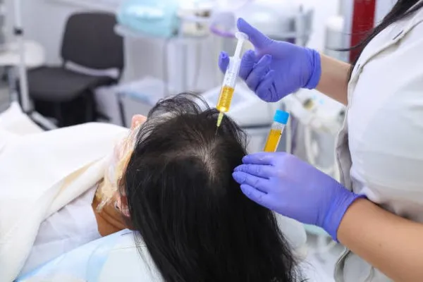 Close-up of doctor administering PRP to a patient’s scalp, showing the precision and care involved in the PRP Hair Treatment Cost procedure