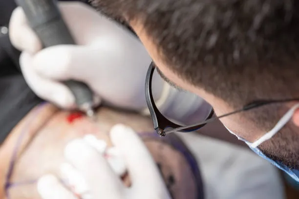 Close-up view of a doctor placing hair grafts using DHI hair transplant technique, achieving even distribution and natural-looking coverage.
