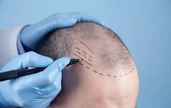 Doctor marking and drawing hairline on a male patient’s scalp, preparing for the transplant procedure in DHI vs FUE Hair Transplant.