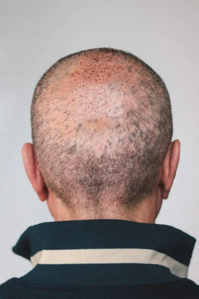 Close-up of a man’s scalp after FUE hair transplant showing fuller coverage and natural results from the follicular unit extraction technique.