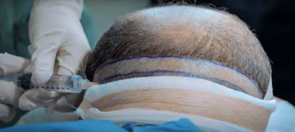 Primer plano de la cabeza de un paciente recibiendo anestesia, con líneas marcadas para la extracción de unidades para el injerto capilar