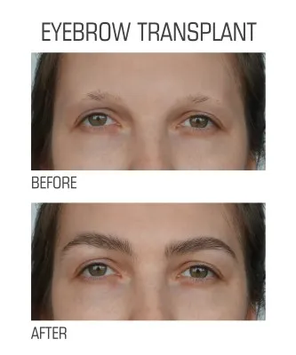 Foto comparativa del rostro de una mujer antes y después del exitoso tratamiento de injerto de cejas con resultados notables