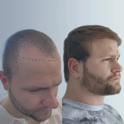 Fotografía de perfil mostrando el resultado del injerto capilar FUE antes y después, con la línea capilar restaurada y mayor densidad