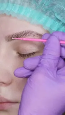 Un cirujano con guantes protectores morados realizando la fase de implantación de un injerto de cejas con una herramienta fina y rosada