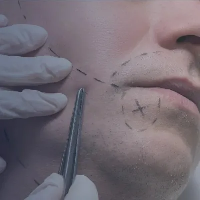 Vista cercana de la zona facial preparada para el injerto capilar de barba, con líneas de marcaje y la aplicación del folículo
