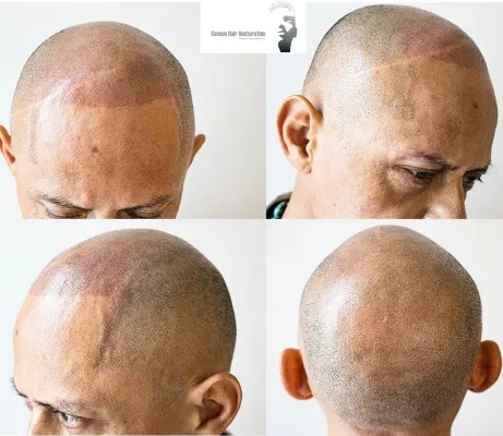 Vistas desde diferentes ángulos de la cabeza mostrando el resultado de la micropigmentación capilar después de disimular cicatrices.