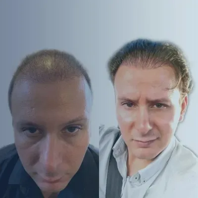 El proceso de injerto capilar FUT antes y después, evidenciando un cabello más fuerte y abundante en la zona frontal