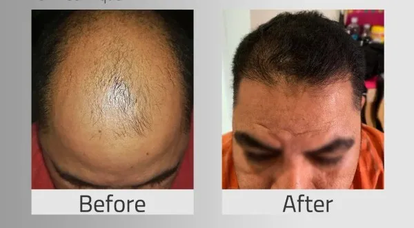 Comparativa de antes y después de un paciente tras someterse a un trasplante de pelo utilizando la técnica capilar FUT.