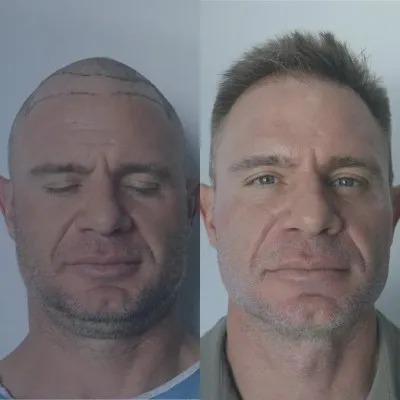 Comparativa de fotografías que evidencia el notable cambio del paciente tras el procedimiento de injerto capilar ARTAS antes y después