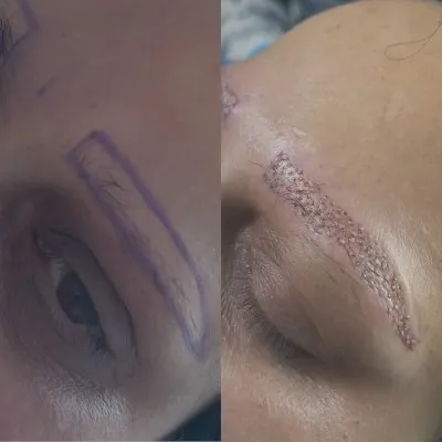 Imagen detallada del proceso de injerto capilar para cejas antes con marcaje y el resultado inmediatamente después de la implantación