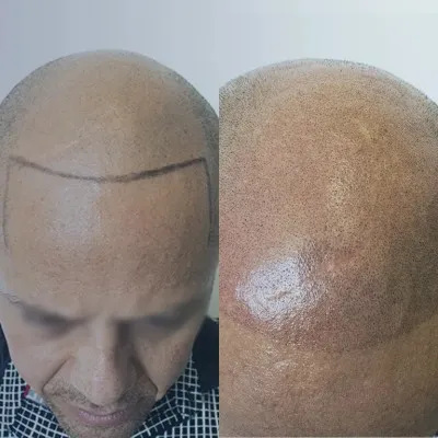 Comparativa visual de micropigmentación en el cuero cabelludo antes y después, dando una apariencia de mayor volumen capilar