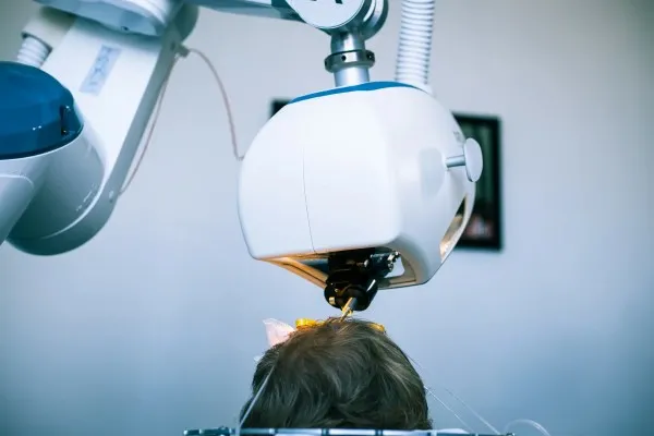 Robot ARTAS de última generación efectuando la extracción de unidades foliculares en un procedimiento de microinjerto capilar.