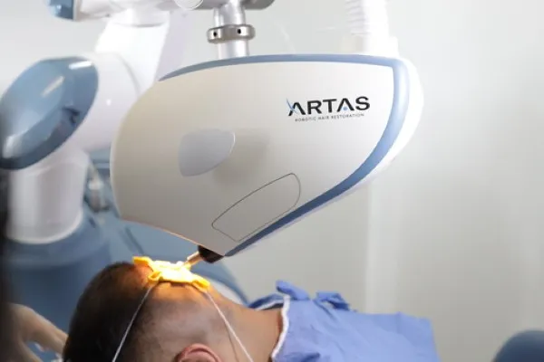 Injerto capilar con tecnología ARTAS