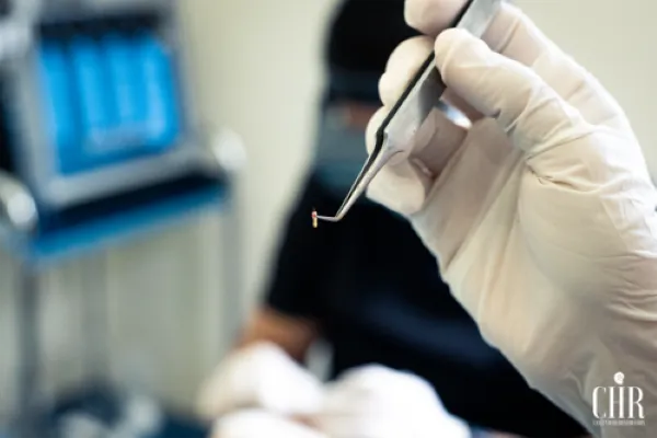 Primer plano de una mano enguantada sosteniendo una unidad folicular lista para ser implantada en el injerto capilar