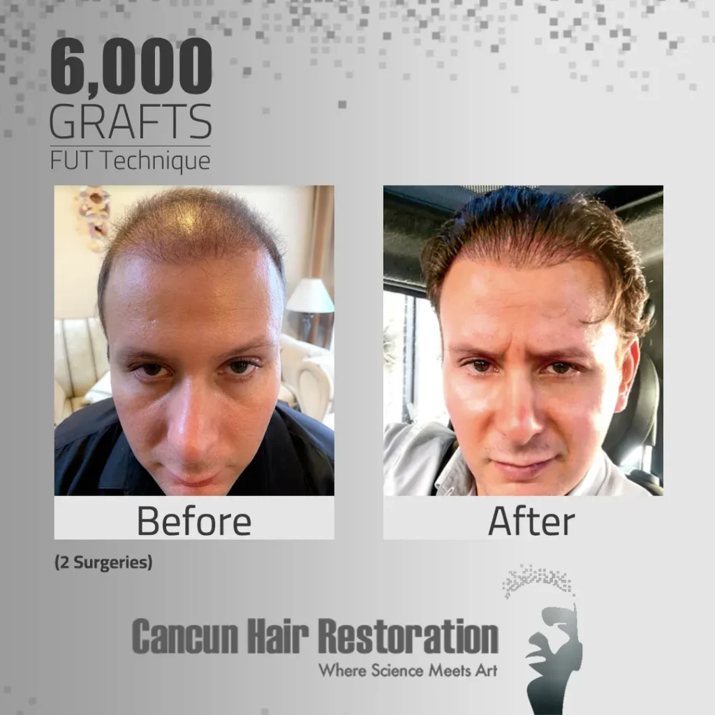 Sexto resultado de una comparación de como se veía un hombre antes y después trasplante FUT