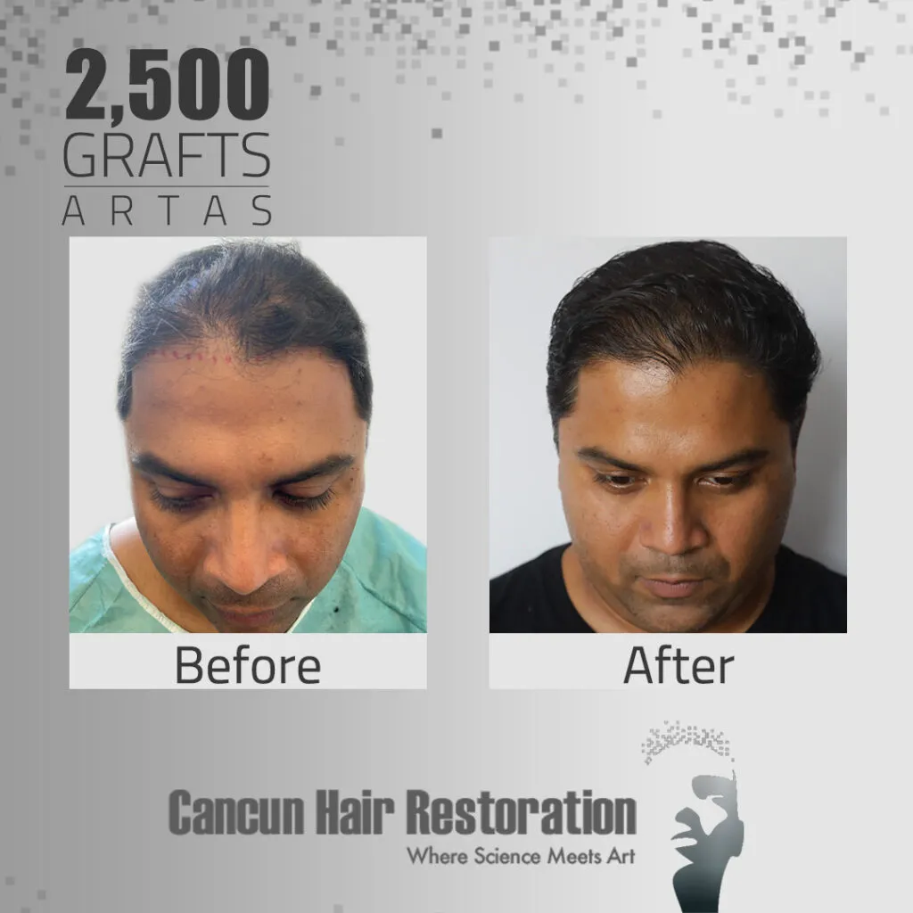 Segundo resultado de una comparación de como se veía un hombre antes y después ARTAS