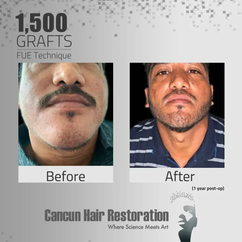 Primer resultado de una comparación de como se veía un hombre antes y después de trasplante de vello facial