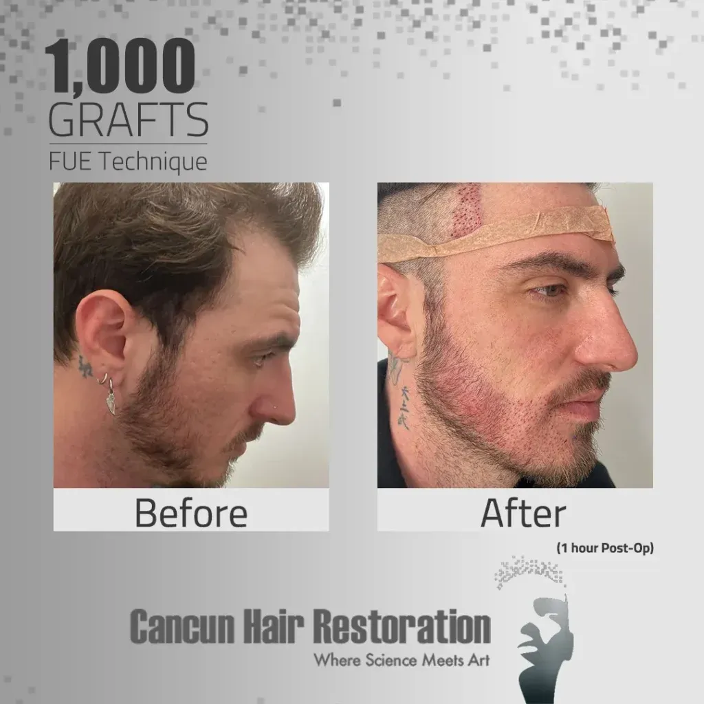 Segundo resultado de una comparación de como se veía un hombre antes y después de trasplante de vello facial