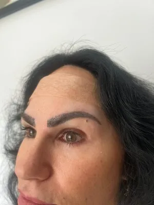 A female patient after an eyeborw hair trnasplant surgery displaying the new shape and defined arch of her natural brows