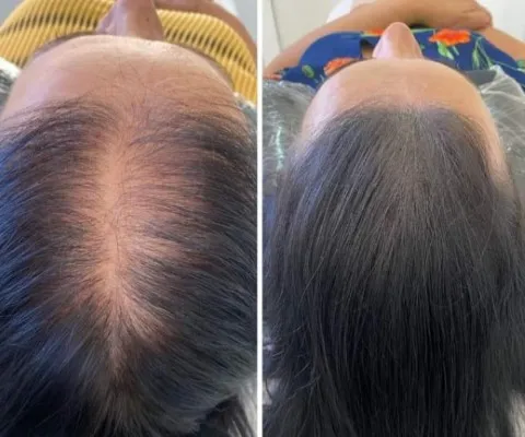Top view of a woman showing scalp micropigmentation results that effectively camouflage thinning hair on the crown area