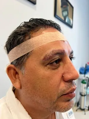 Lateral view of a male patient showing the immediate post operative phase of an eyeborw hair trnasplant for thickness