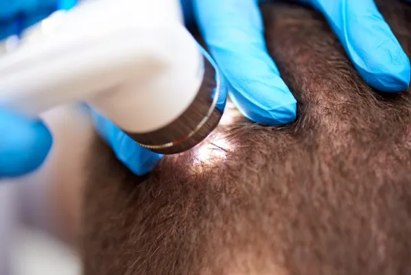 Scalp micropigmentation treatment in a man to boost his confidence