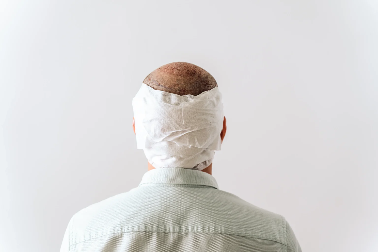 ARTAS robot hair transplant: is it worth it?