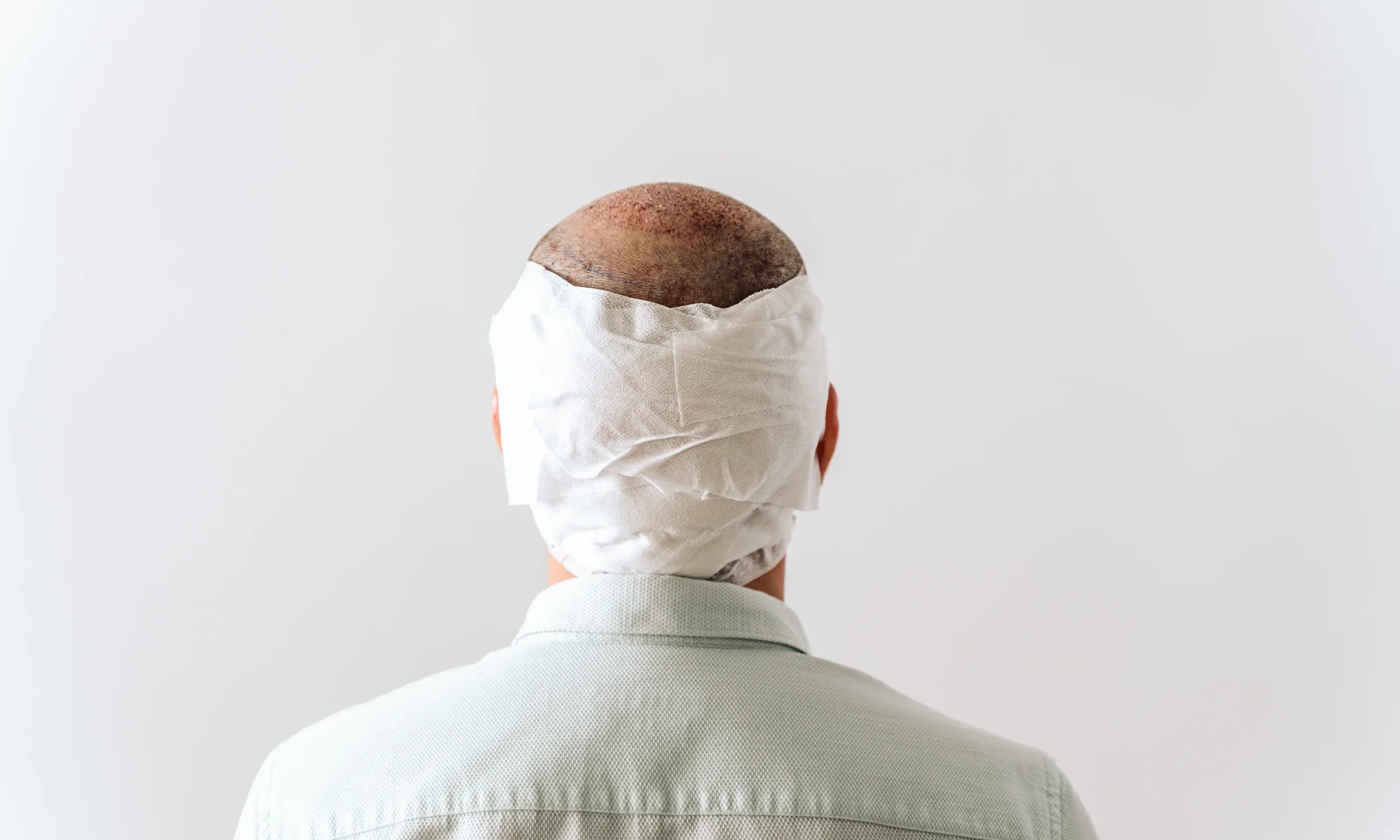 Back of a male patient wearing a medical bandage post an ARTAS hair transplant robotic surgery session.