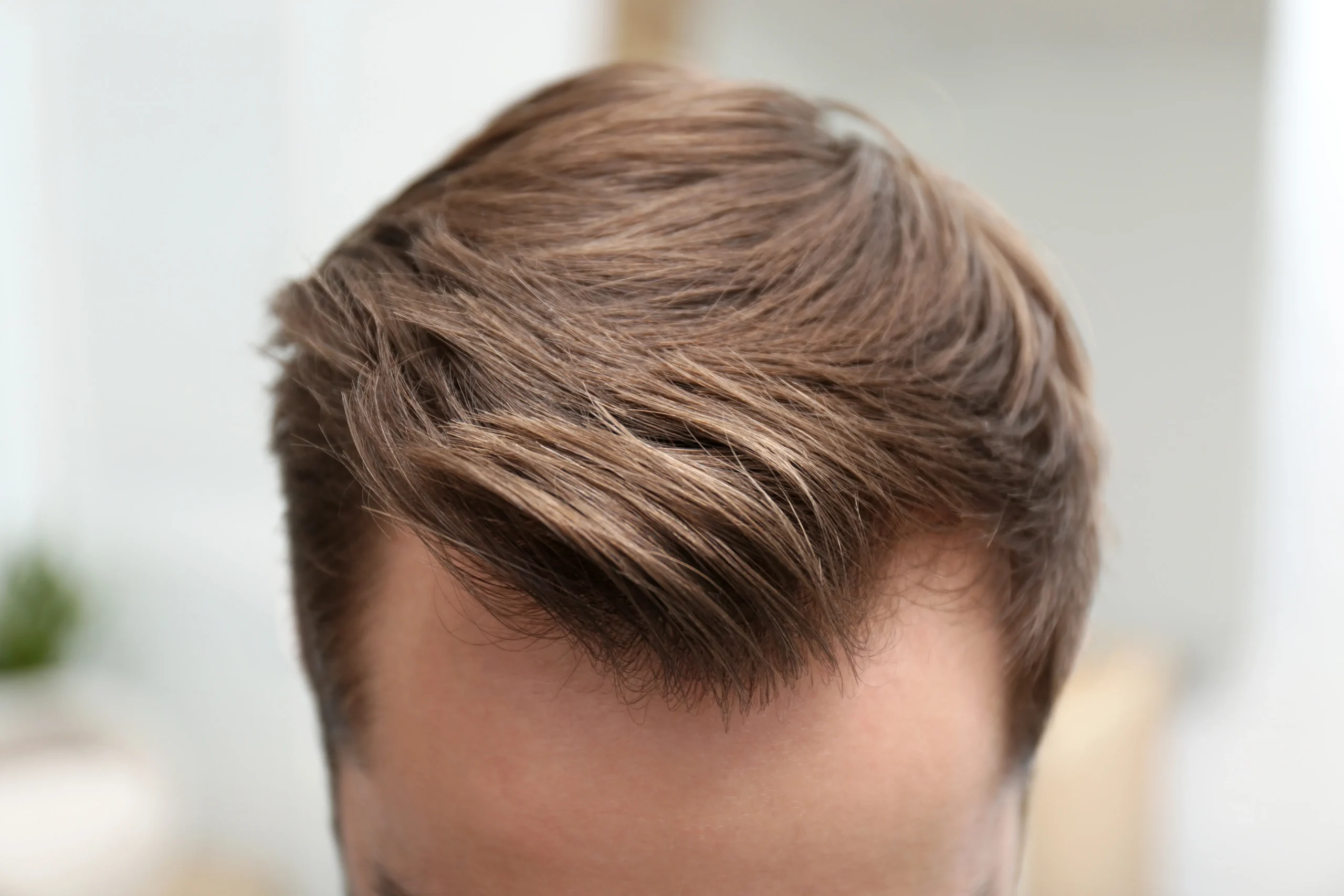 Natural looking hair density and restored hairline achieved via a modern ARTAS hair transplant technique.